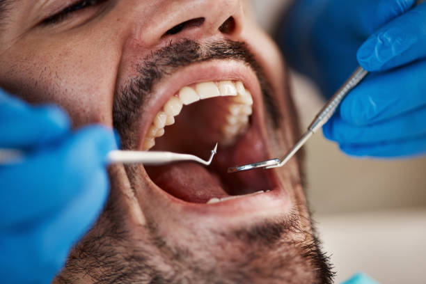 Best Dental Fillings (Composite and Amalgam)  in Cascade Valley, WA